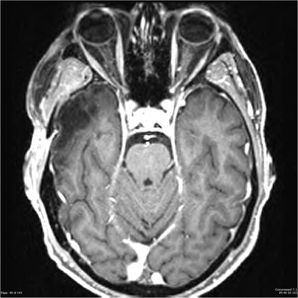 File:Anaplastic meningioma with recurrence (Radiopaedia 34452-35788 Axial T1 C+ 48).jpg