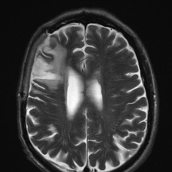 File:Anaplastic meningioma with recurrence (Radiopaedia 34452-35788 Axial T2 18).png