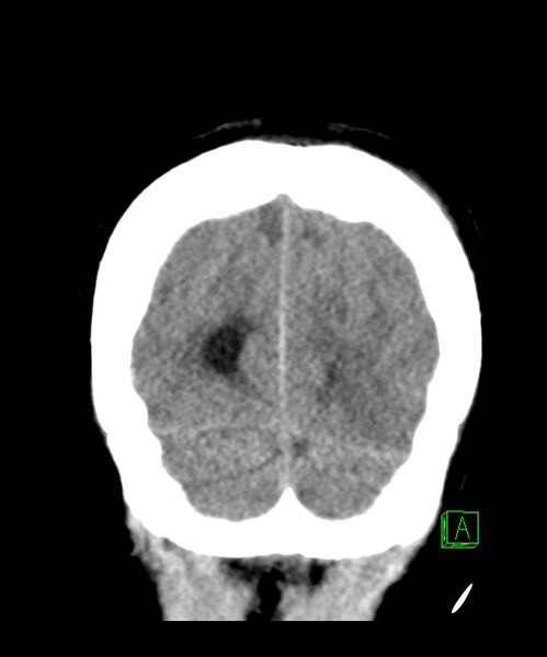 File:Angiomatous meningioma (Radiopaedia 79459-92578 Coronal non-contrast 32).jpg