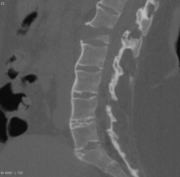 File:Ankylosing spondylitis - chalk stick fracture (Radiopaedia 4832-6790 Sagittal bone window 1).jpg
