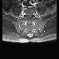 Ankylosing spondylitis with zygapophyseal arthritis (Radiopaedia 38433-40517 D 8).jpg