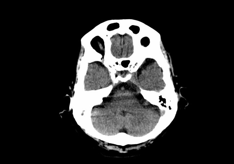 File:Anomalous intracranial venous drainage (Radiopaedia 28161-28418 Axial non-contrast 10).jpg