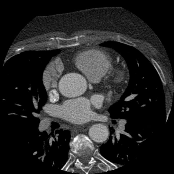 File:Anomalous origin of left circumflex artery from right coronary sinus (Radiopaedia 72563-83117 B 41).jpg