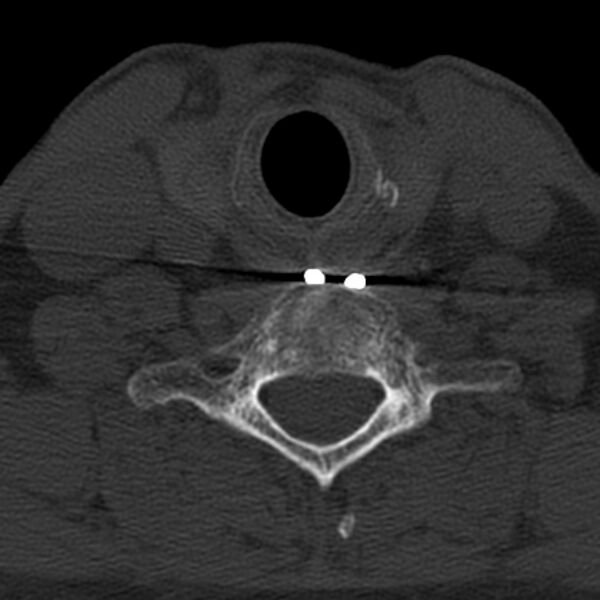 File:Anterior cervical postdiscectomy arthrodesis (Radiopaedia 32678-33646 Axial bone window 57).jpg