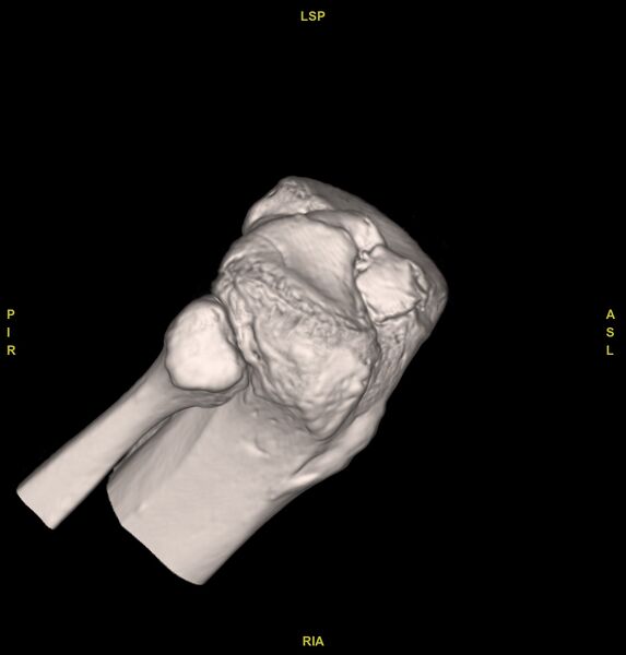 File:Anterior cruciate ligament avulsion fracture (Radiopaedia 58939-66194 VRT 3).jpg