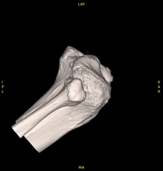 File:Anterior cruciate ligament avulsion fracture (Radiopaedia 58939-66194 VRT 6).jpg