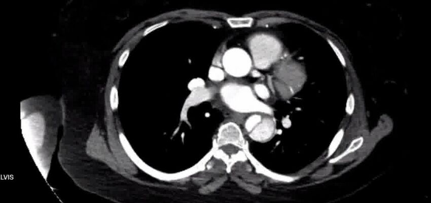 Aortic Dissection (Radiopaedia 85272-100847 A 23).jpg