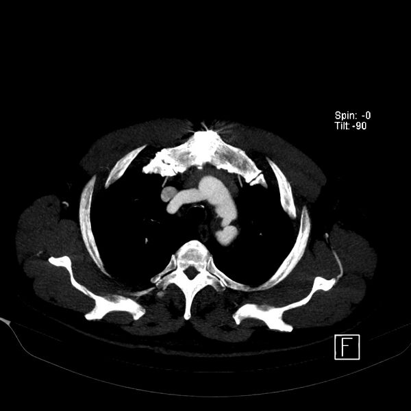 File:Aortic dissection - De Bakey type III - Stanford B (Radiopaedia 21903-21882 B 13).jpg