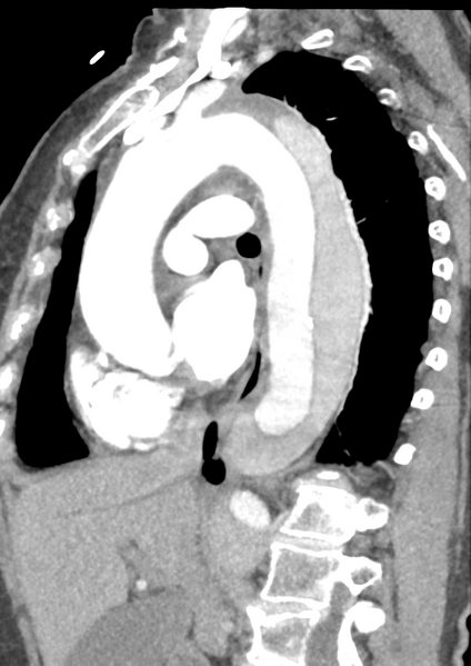 File:Aortic dissection - Stanford type B (Radiopaedia 50171-55512 C 28).png