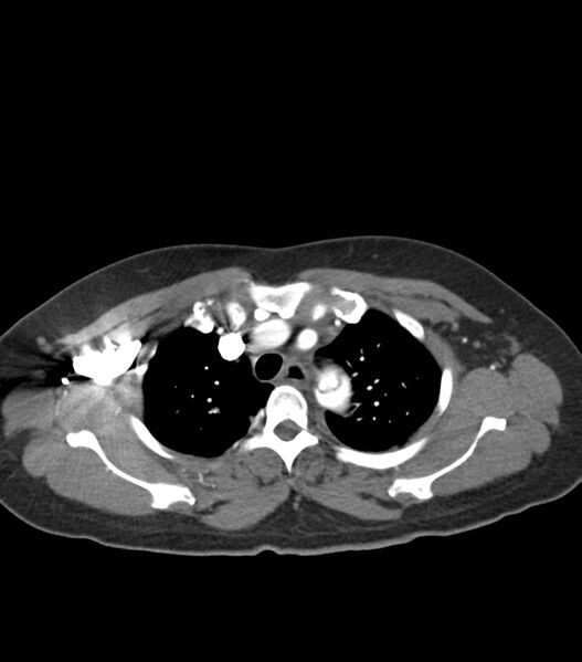 File:Aortic dissection with renal ischemia (Radiopaedia 76573-88338 A 10).jpg