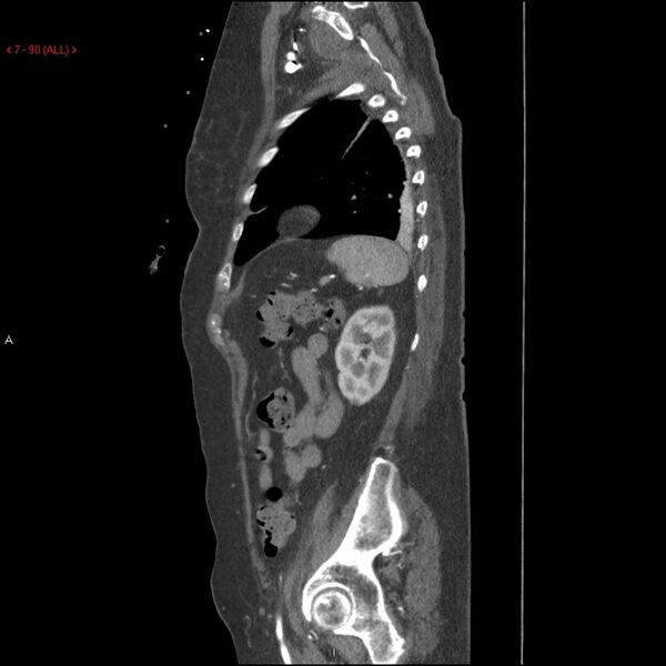 File:Aortic intramural hematoma (Radiopaedia 27746-28001 C 59).jpg