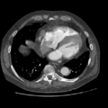 Aorto-coronary bypass graft aneurysms (Radiopaedia 40562-43157 A 87).png