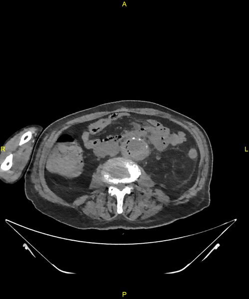 File:Aortoenteric fistula (Radiopaedia 84308-99603 Axial non-contrast 192).jpg