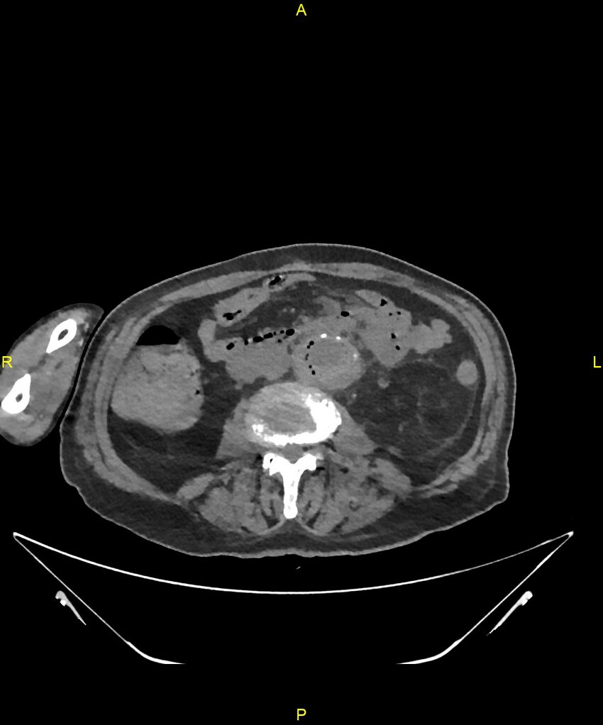 Aortoenteric fistula (Radiopaedia 84308-99603 Axial non-contrast 192).jpg