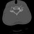 Apical pneumothorax on cervical spine CT (Radiopaedia 45343-49368 Axial bone window 61).jpg