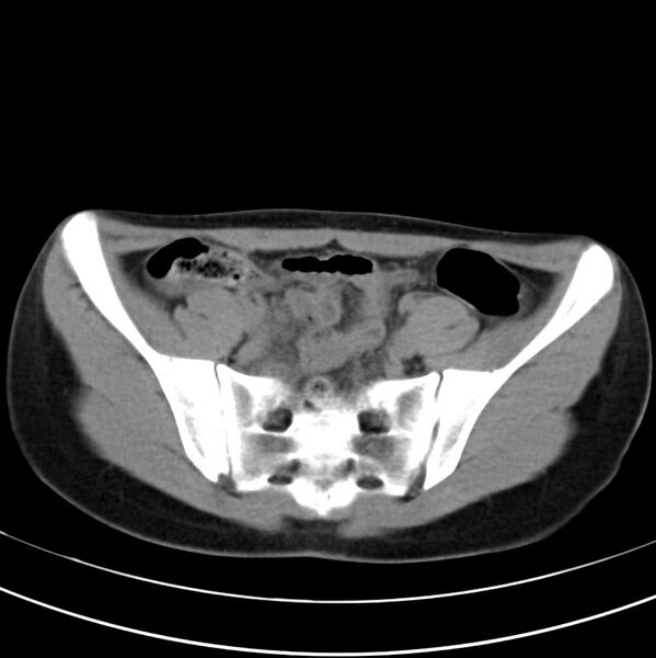 File:Appendicitis and incidental bicornuate uterus (Radiopaedia 22833-22853 Axial non-contrast 35).jpg
