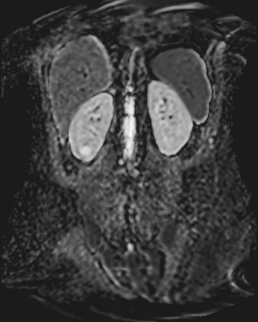 Appendicitis in gravida (MRI) (Radiopaedia 89433-106395 Coronal ADC 44).jpg