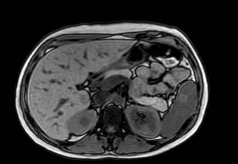 File:Appendicitis in gravida (MRI) (Radiopaedia 89433-106395 D 16).jpg