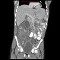 Appendicitis with phlegmon (Radiopaedia 9358-10046 B 31).jpg