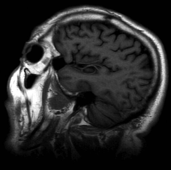 File:Arachnoid cyst - middle cranial fossa (Radiopaedia 9016-9775 Sagittal T1 1).jpg
