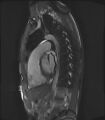 Arrhythmogenic right ventricular cardiomyopathy (Radiopaedia 57972-64966 Cine RVOT SSFP 2).jpg