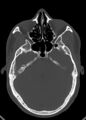 Arrow injury to the head (Radiopaedia 75266-86388 Axial bone window 58).jpg