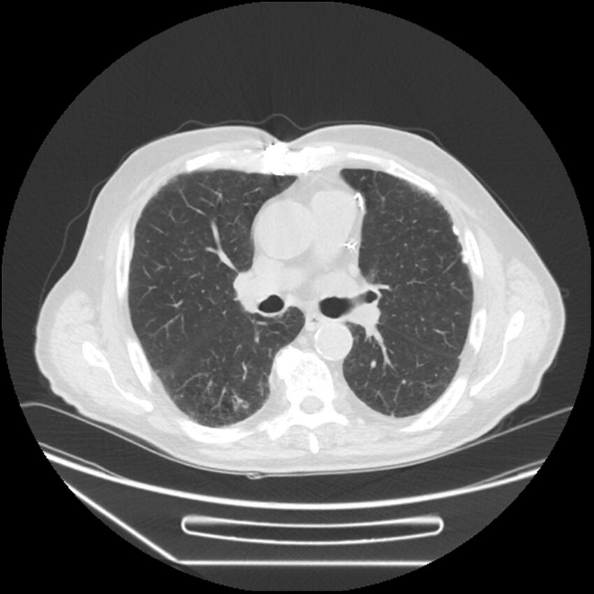 Asbestosis complicated by lung cancer (Radiopaedia 45834-50116 Axial lung window 32).jpg