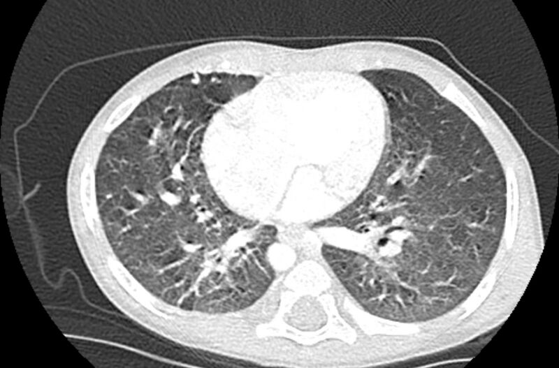 File:Asplenia syndrome (Radiopaedia 73083-83792 Axial lung window 44).jpg