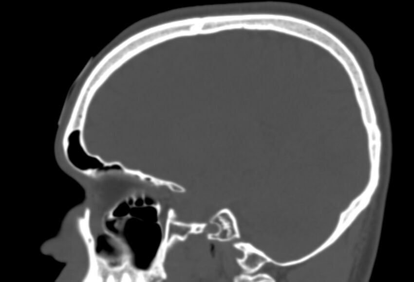 Asymptomatic occipital spur (Radiopaedia 87753-104201 Sagittal bone window 111).jpg