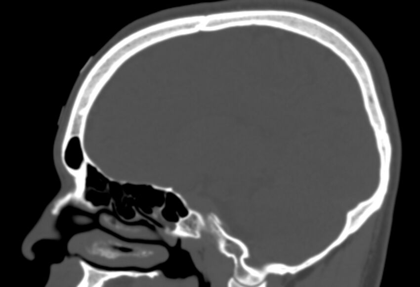 Asymptomatic occipital spur (Radiopaedia 87753-104201 Sagittal bone window 129).jpg