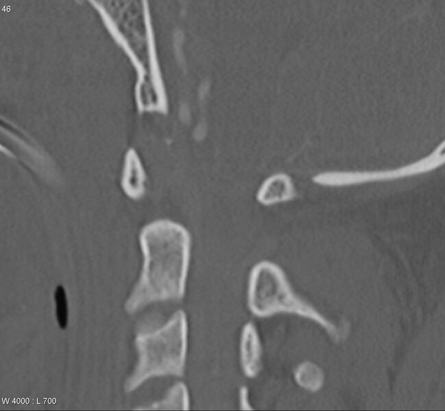 File:Atlanto-axial separation (Radiopaedia 4600-6704 Sagittal bone window 5).jpg