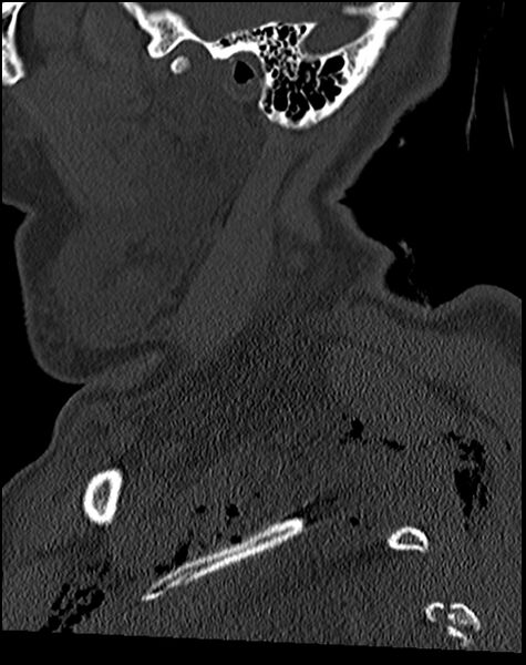 File:Atlanto-occipital dissociation - Traynelis type 1 (Radiopaedia 87570-103948 Sagittal bone window 17).jpg