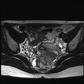 Atypical deep infiltrating endometriosis (Radiopaedia 44470-48125 Axial T2 14).jpg