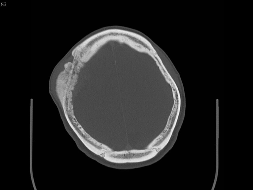 Atypical meningioma - intraosseous (Radiopaedia 64915-73867 Axial C+ bone window 53).jpg