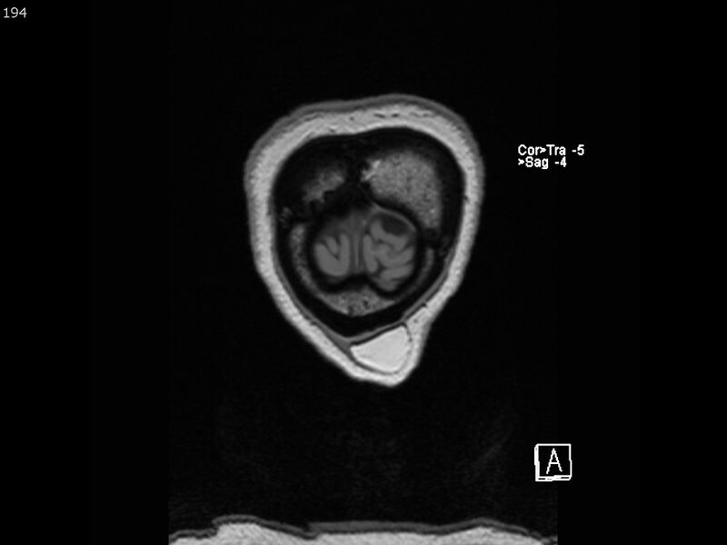File:Atypical meningioma - intraosseous (Radiopaedia 64915-74572 Coronal T1 194).jpg