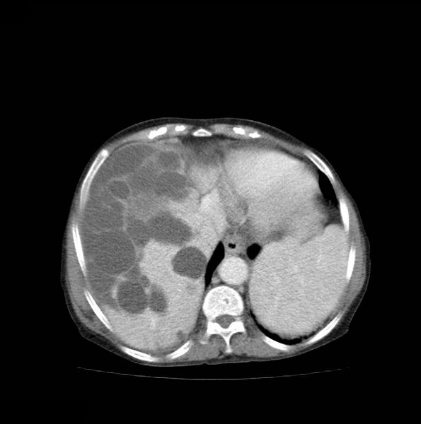 File:Autosomal dominant polycystic kidney disease (Radiopaedia 16777-16490 A 9).jpg
