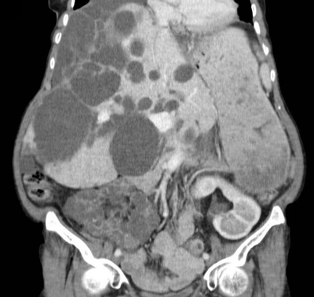 File:Autosomal dominant polycystic kidney disease (Radiopaedia 16777-16490 B 20).jpg