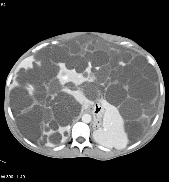 File:Autosomal dominant polycystic kidney disease with extensive hepatic involvement (Radiopaedia 5204-6971 B 5).jpg