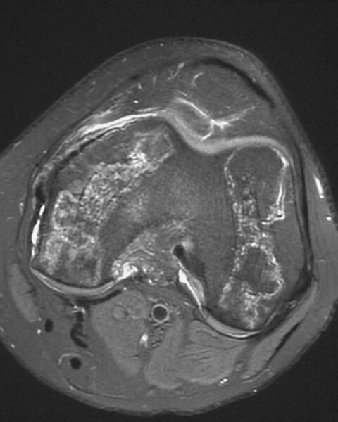 File:Avascular necrosis of the knee (Radiopaedia 2583-6277 Axial T2 1).jpg