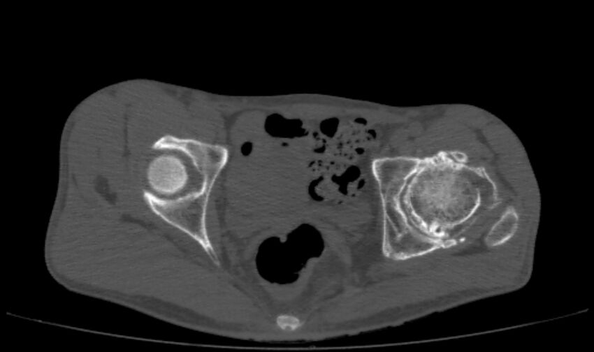 Avascular necrosis of the left hip (Radiopaedia 75068-86125 Axial bone window 40).jpg