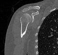 Avulsion fracture - greater tuberosity of humerus (Radiopaedia 71216-81514 Coronal bone window 26).jpg