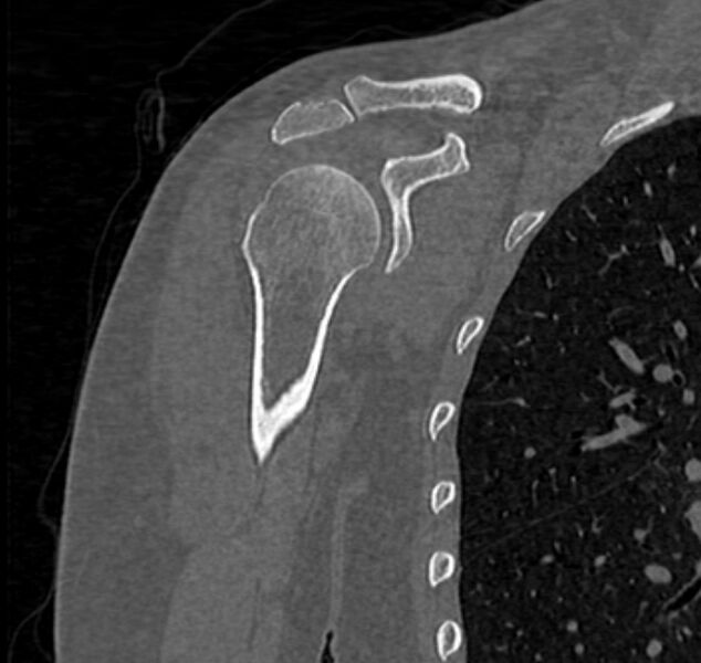 File:Avulsion fracture - greater tuberosity of humerus (Radiopaedia 71216-81514 Coronal bone window 26).jpg