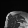 Avulsion fracture - greater tuberosity of humerus (Radiopaedia 71216-81515 Coronal T1 2).jpg