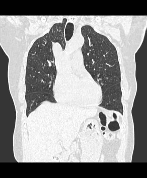 File:Azygos fissure and azygos lobe (Radiopaedia 41841-44832 Coronal lung window 4).jpg