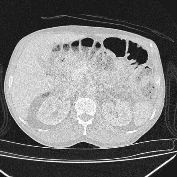 File:Azygos lobe (Radiopaedia 38259-40275 Axial lung window 93).jpg