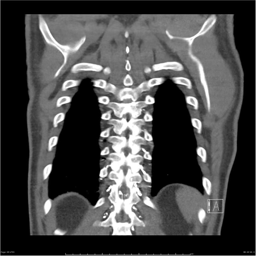 Azygos venous system anatomy (CT pulmonary angiography) (Radiopaedia 25928-26077 Coronal C+ CTPA 68).jpg