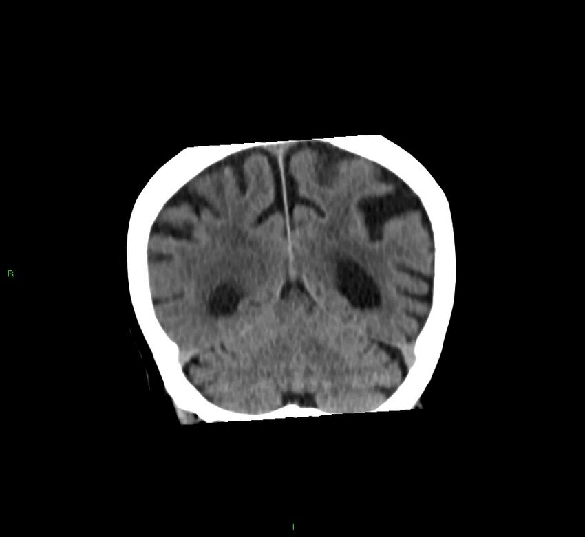 Basal ganglia hemorrhage (Radiopaedia 58762-65984 Coronal non-contrast 20).jpg