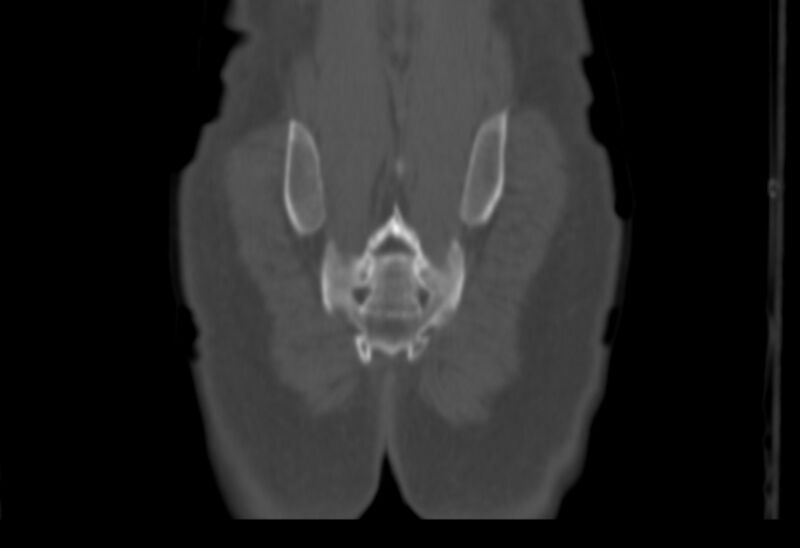 File:Bertolotti syndrome (Radiopaedia 58974-66235 Coronal bone window 1).jpg
