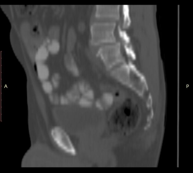 File:Bertolotti syndrome (Radiopaedia 58974-66235 Sagittal bone window 31).jpg