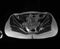 Bicornuate bicollis uterus (Radiopaedia 61626-69616 Axial T2 14).jpg